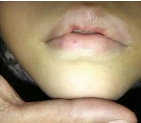艾滋病早期嘴唇图片 (9)