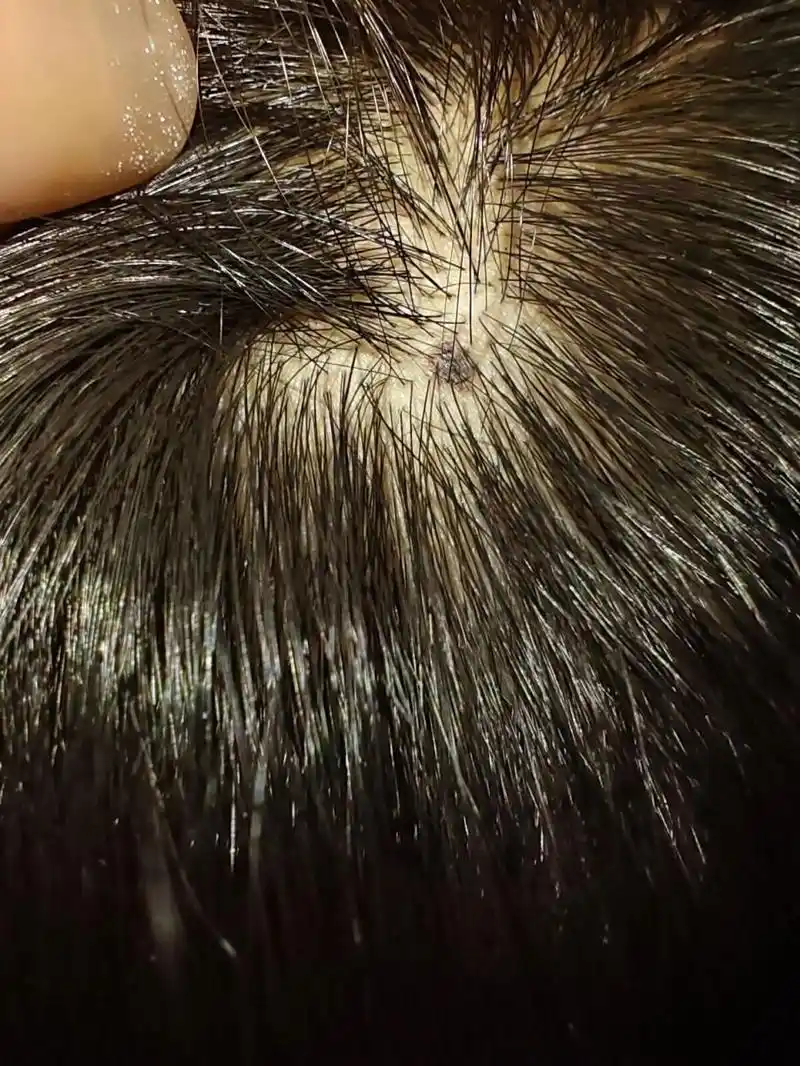 突然发现孩子头皮上长了颗黑痣   有懂得吗 这痣有问题吗