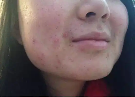 丘疹型痤疮的治疗,护理