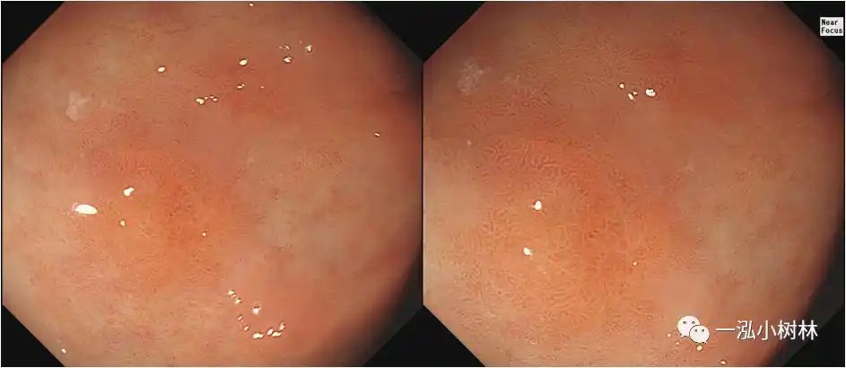 一例早期胃癌病例分享