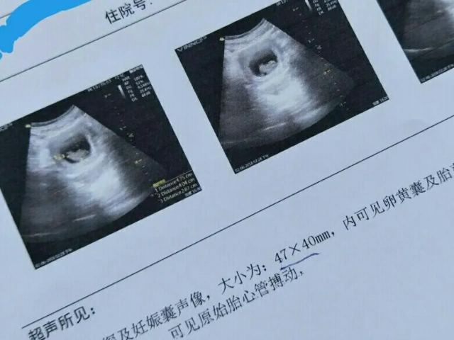 陈旧!孕囊大小对照表"物归原主"-第2张图片-追风博客