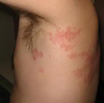 辟谣丨"缠腰龙","蛇盘疮"身上长一圈就会死人?医生:假的_手机搜狐网