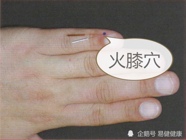 中医健康养生之人体手部穴位火膝穴