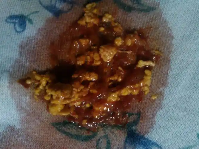 大便照片高清,痔疮大便出血大便照片-图片大观-奇异网