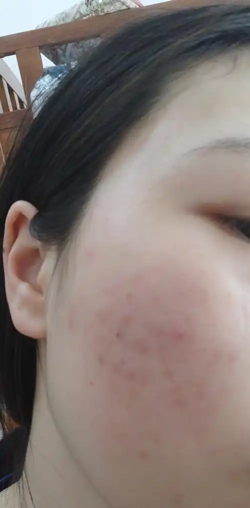 口罩捂出毛囊炎更新好的差不多啦