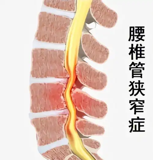 这就是腰椎管狭窄和其症状