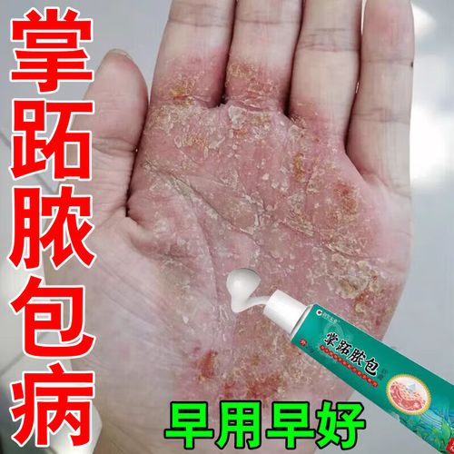 掌趾脓包病专用膏药治手脚脱蜕皮干裂掌跖脓包角化症红斑外用膏x 单