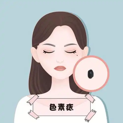 全身胎记图解(各种胎记和斑痣解析大全)