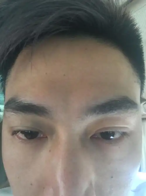 感觉有点眼突是不是得了甲亢?