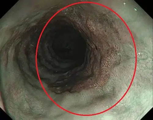 胃镜能发现早期食管癌吗