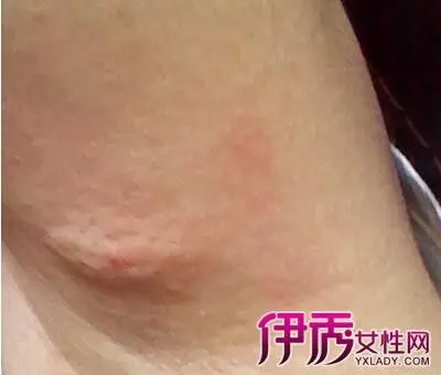 【图】男性腋下有硬块疼痛 淋巴结肿大的常见原因