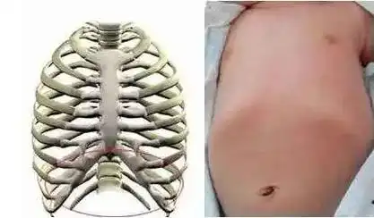 儿童健康守护者计划#宝宝肋骨外翻大多是生理性的.