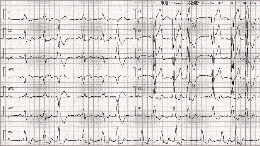 心电图图库室性早搏系列