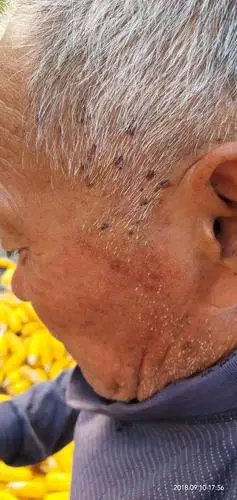 老人脸上长黑斑是怎么回事