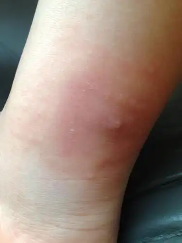 脚被蚂蚁咬了 越来越严重 而且手上长了好多水泡 去医院只是让我吃些