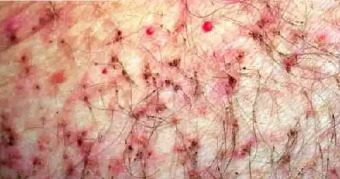 男性阴虱晚期症状图