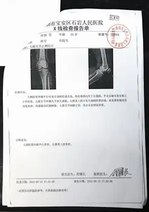 腿被踢骨折的黄先生在诉说事情经过.黄先生的病例.