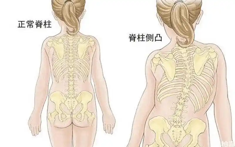 儿童脊柱侧弯训练有方法瑜伽呼吸动作结合才能救娃