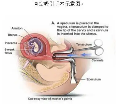 人工流产手术的种类