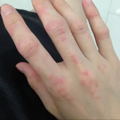 手指关节手背长红点几天后会变成红色一块一块的,请问是什么病,怎么治