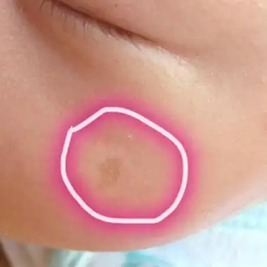 我想知道宝宝脸上这个是什麼东西,如果是胎记,但生下来的时候并没有.