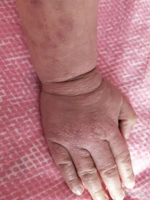 请帮我看看我家宝宝的严重的慢性干性湿疹能不能好,跪谢!