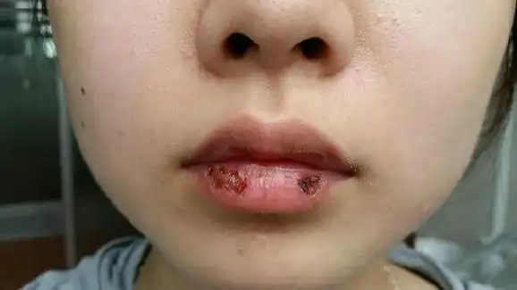 原发性疱疹性口炎 - 好大夫在线