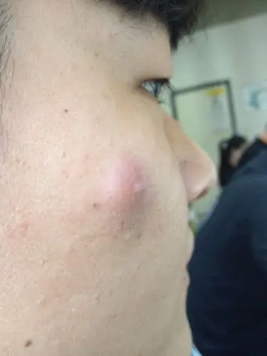 脸上长了一个大包,请问这是什么症状,怎么解决,详细点?看下图