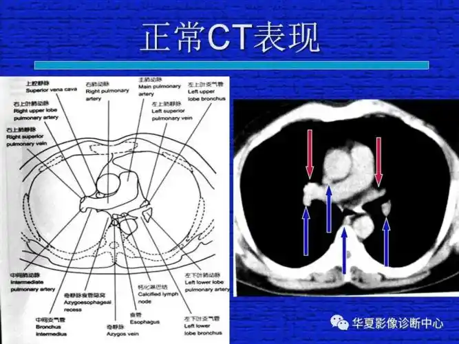 ct入门结合解剖谈正常胸部ct读片