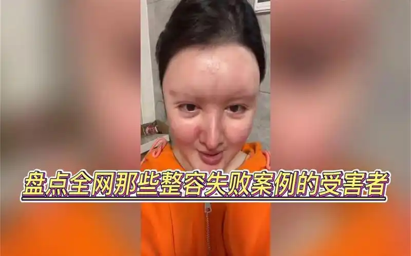 盘点全网整容失败案例:身体发肤授之父母,想整容的需三思啊