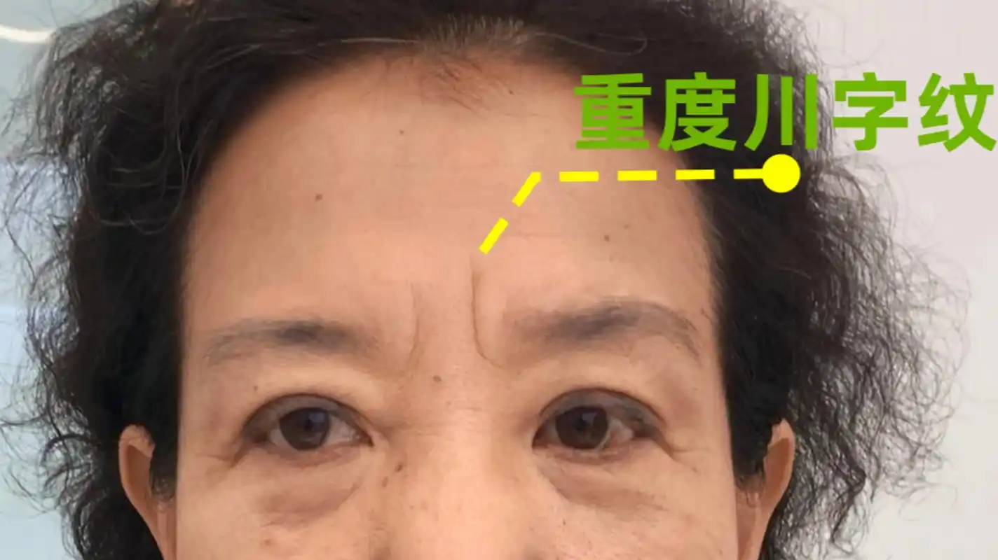 北京朝阳大姐川字纹很重,切除后3个月眉间平了,家里人都夸年轻,心里倍