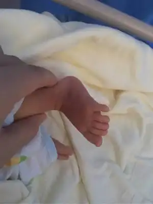 新生儿足外翻,治愈的可能性大吗?