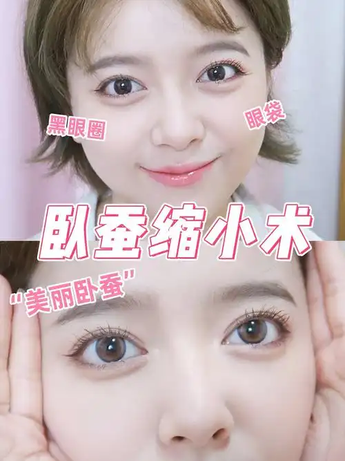 卧蚕太大真的很像眼袋99