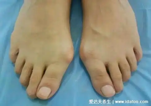 看图片,拇外翻是这样的,大脚趾旁边像多长出了一块骨头,脚的拇趾骨和