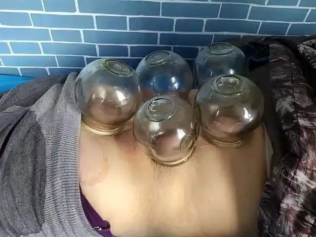 医生给进行了针灸和拔罐,治疗后情况有所好转,医生还嘱咐他平时多注意