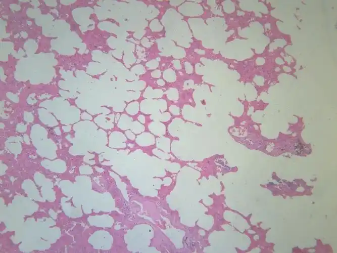 小叶性肺炎显微图片第10张