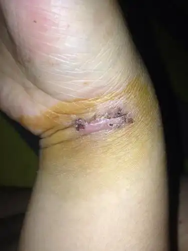 腕部被玻璃划伤缝针 昨天拆线 请问自己在家可以用双氧水碘伏清洗局部