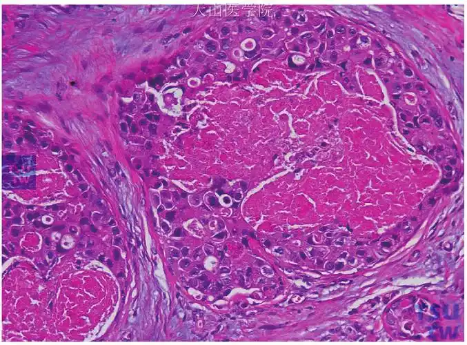 高级别导管原位癌