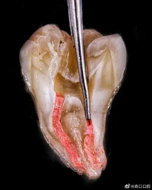 简单直接展示一下根管治疗过程,医生在牙里都干了啥.#根管治疗