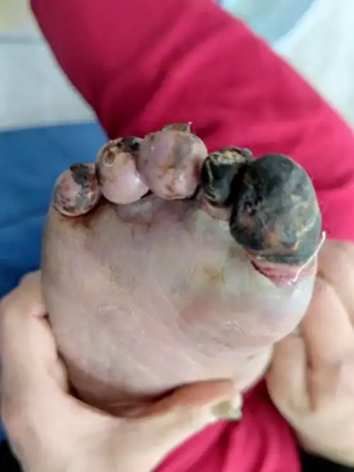 四年前查出甲状腺恶性肿瘤,当时手术治疗后效果良好,两年内定期检查