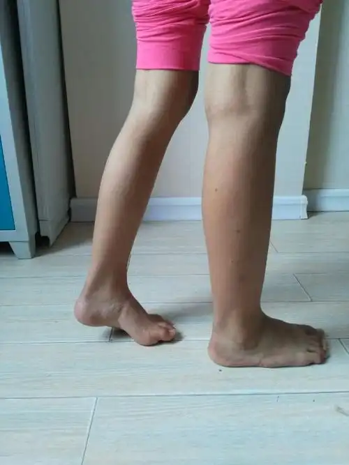 马蹄内翻足的简化软组织平衡手术