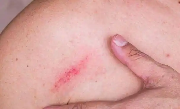 糖尿病患者还可能出现周围神经病变,这可能表现为轻度的皮肤瘙痒,但更