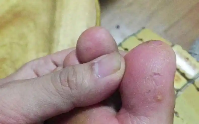 水泡型脚气治疗方式