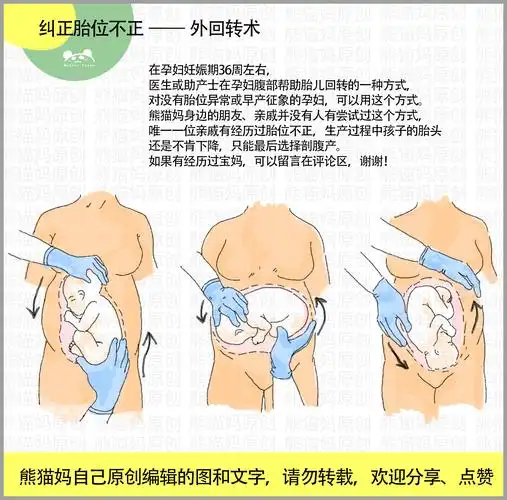 矫正胎位不正6技巧:臀位体操,左侧卧位,外回转术,和胎儿说话