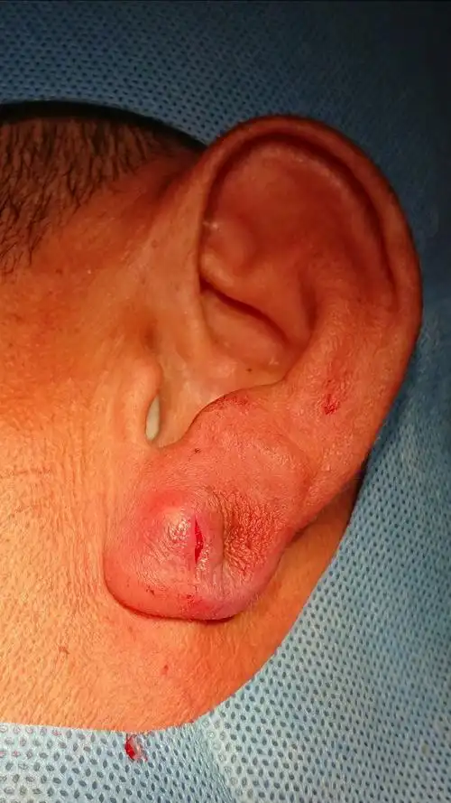 耳垂皮脂腺囊肿感染