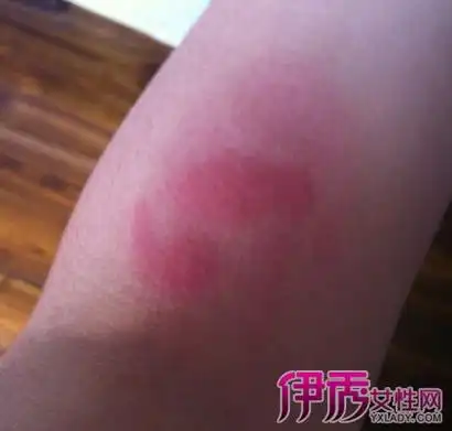 被蟑螂咬了怎么办?如何辨认蟑螂咬人的伤口-知言识新