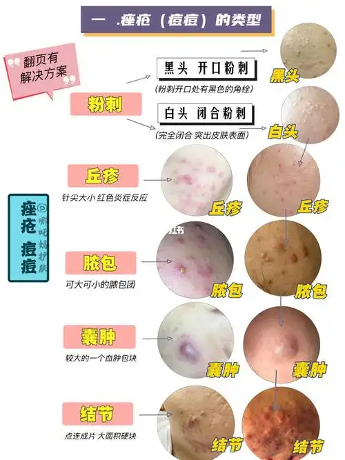 青春痘-卓跃网-关注卓越生活