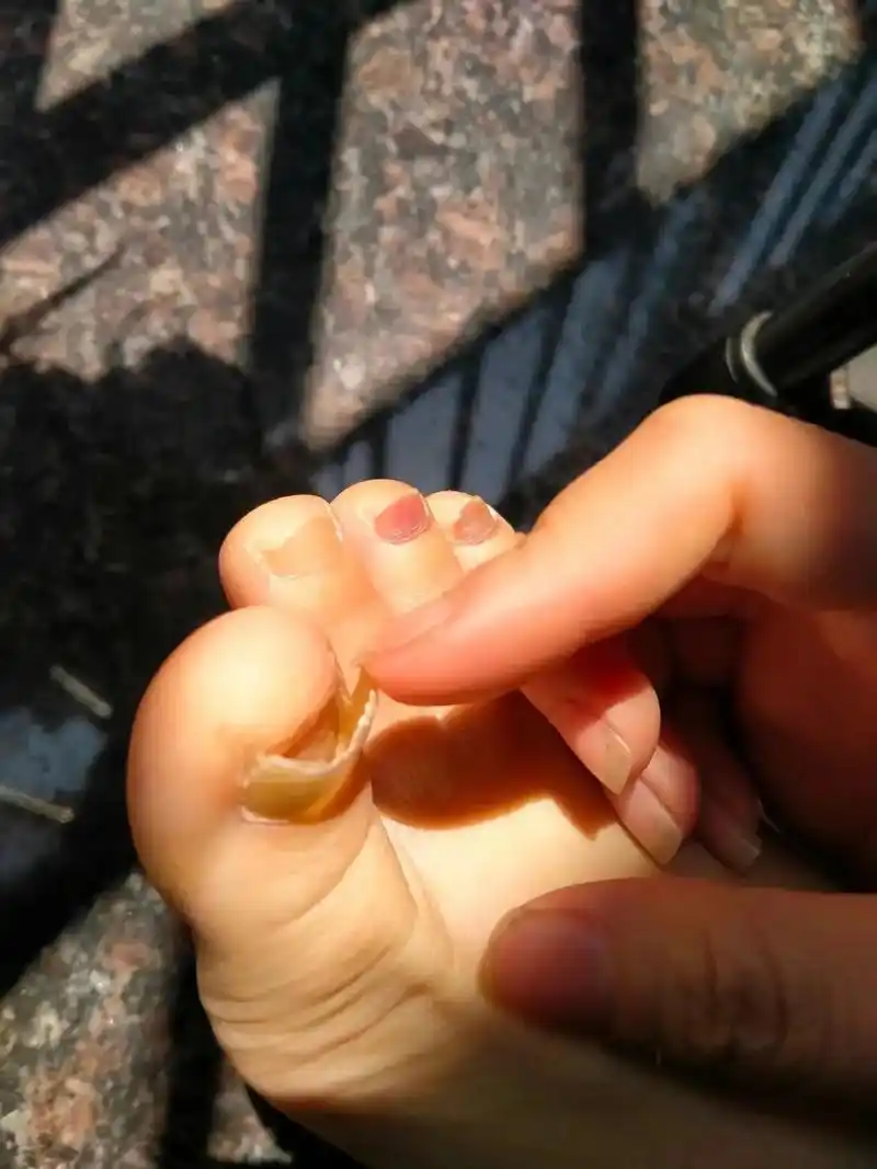 我曾十个脚指甲脱落不喊疼,直到有人说选择大于努力,我深刻怀疑 - 抖