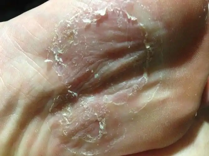 来自移动用户 十几年双脚一年四季脱皮,查无真菌感染 双脚上有湿疹