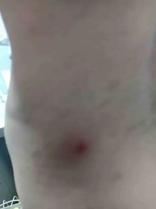 孩子十一岁 腰上起个大包流脓血水 一碰就疼 是什么病 怎么治疗